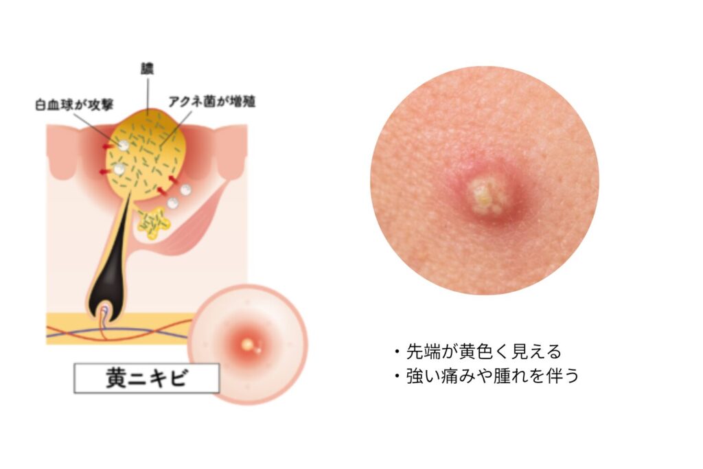 黄ニキビ:膿が溜まった状態
