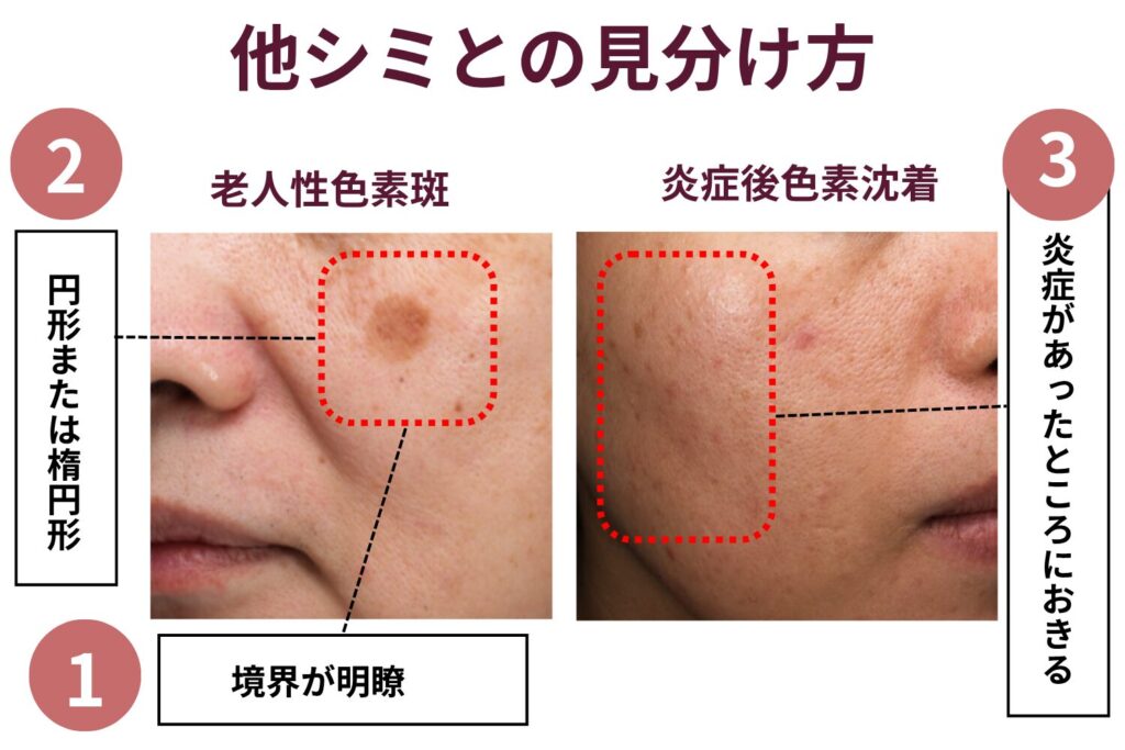 他シミの特徴