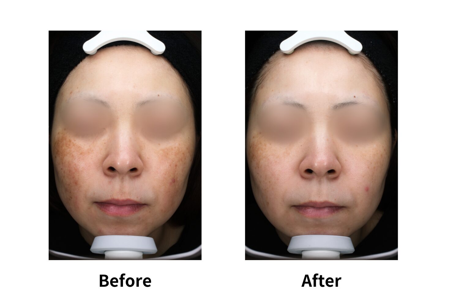 肝斑やそばかす、毛穴・くすみなど多様な肌悩みに対応できる