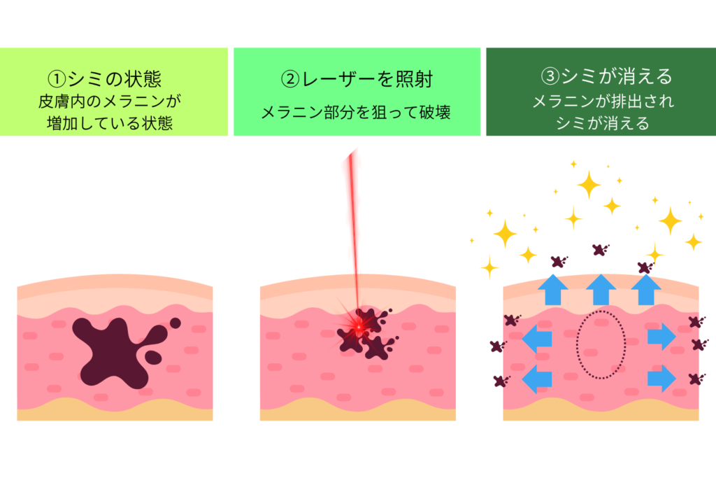 シミ取りレーザーがメラニン色素に作用する仕組み
