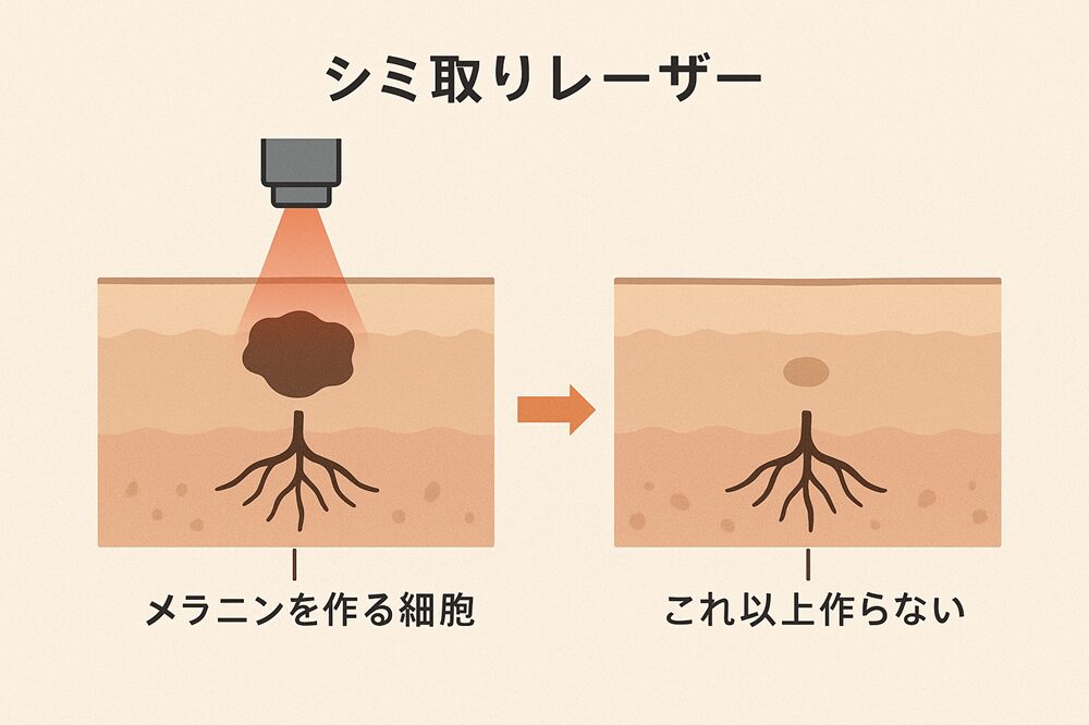 シミ取りレーザーのメカニズム