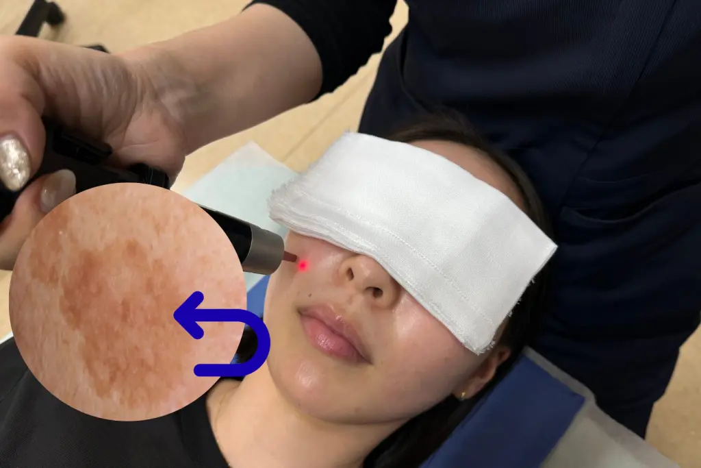 シミ取り後再発する?戻りジミかレーザーの失敗か?