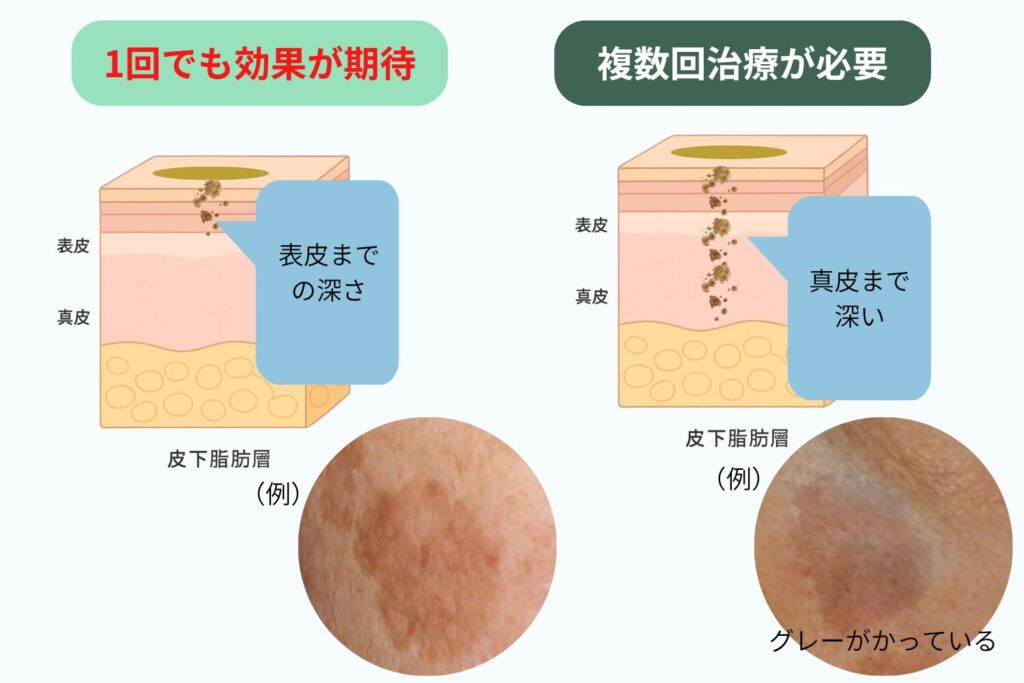 シミ取りは何回で効果が出る?まず理解しておくべき基本