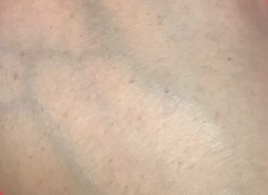 ライムライト(広範囲のくすみに)