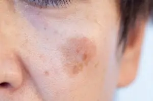 男性のシミの特徴