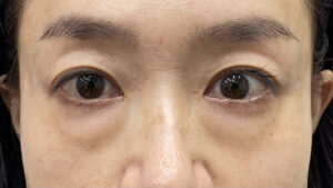 クマ取りビフォー