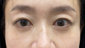 クマ取りアフター