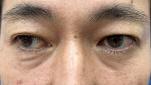 くまとりアフター