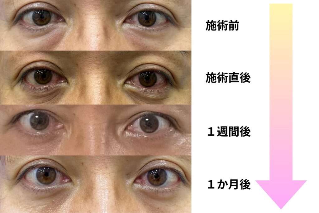 クマ取りの経過画像