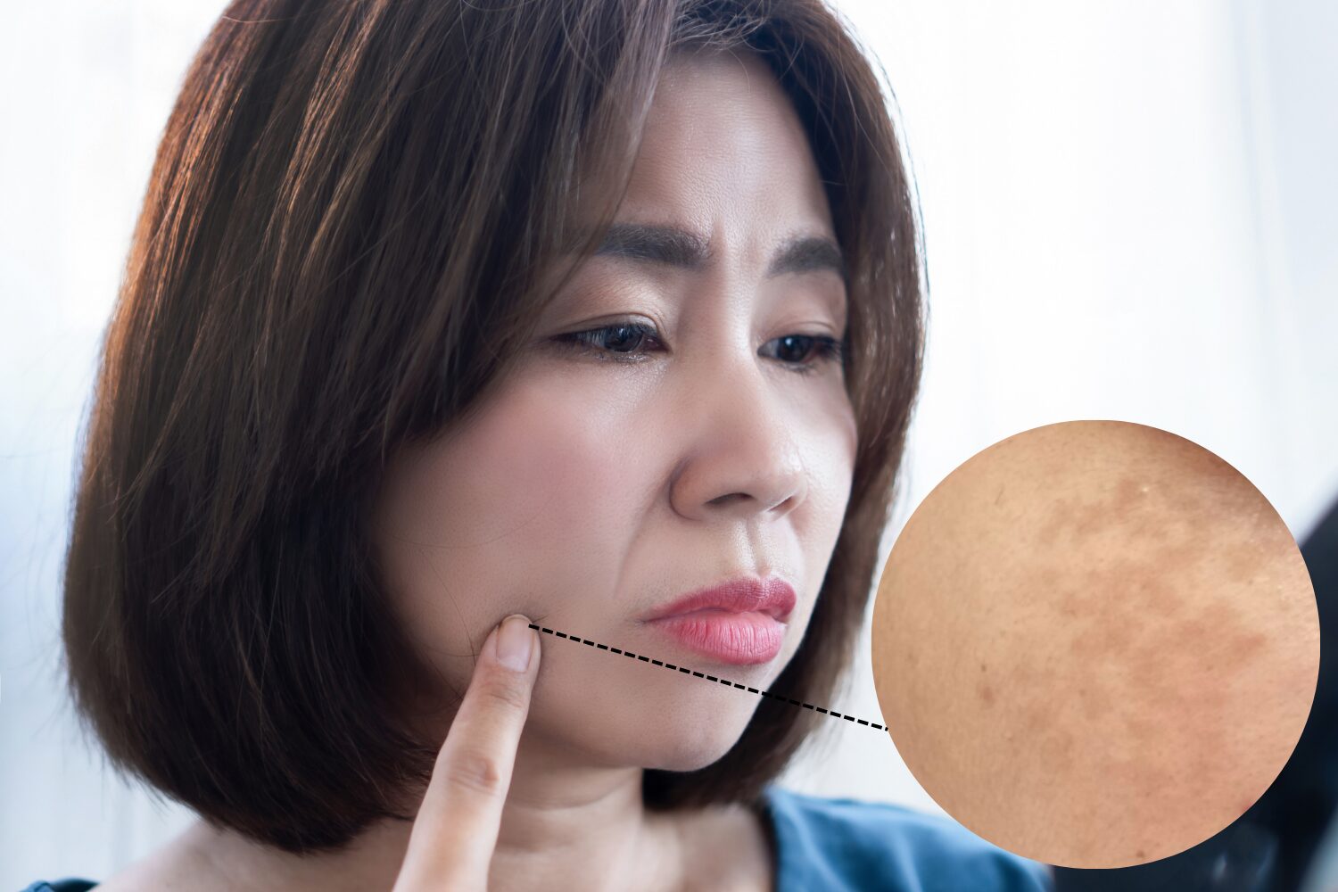 薄いシミも諦めない!原因と最適な治療法を医師が徹底解説