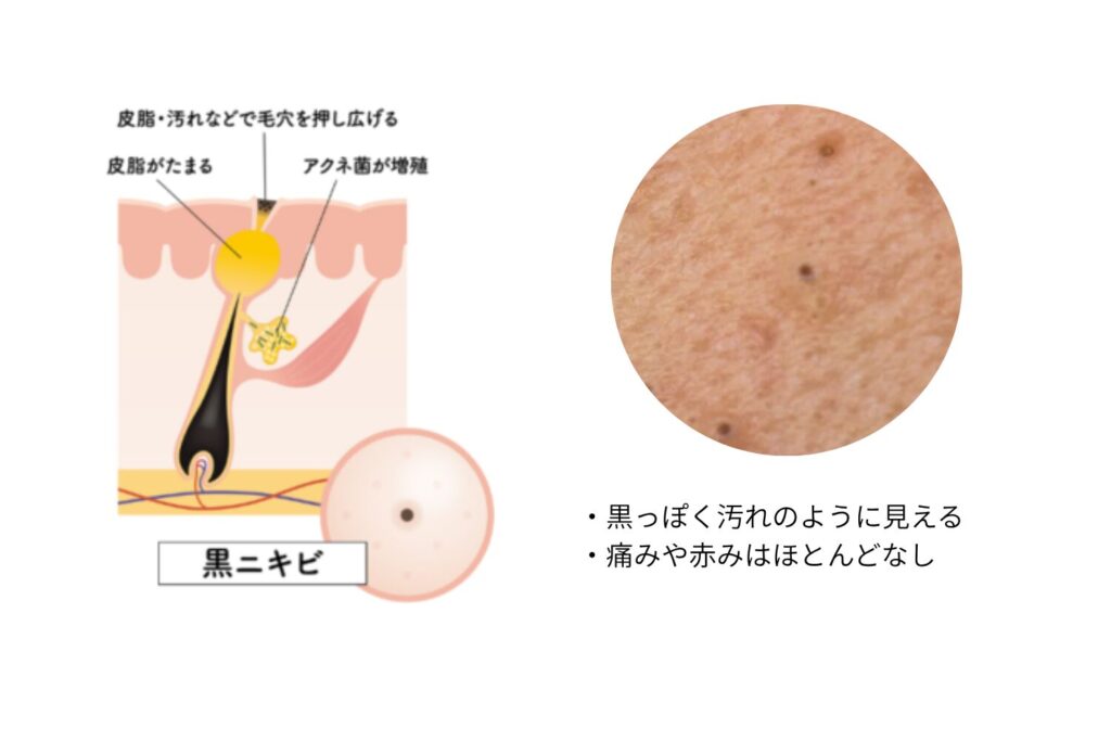 黒ニキビ:酸化による黒ずみ