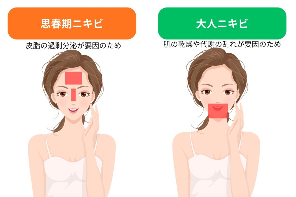 思春期ニキビと大人ニキビの違いは?