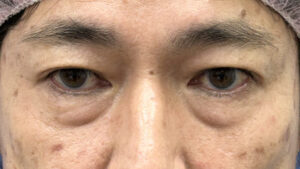 くまとりビフォー