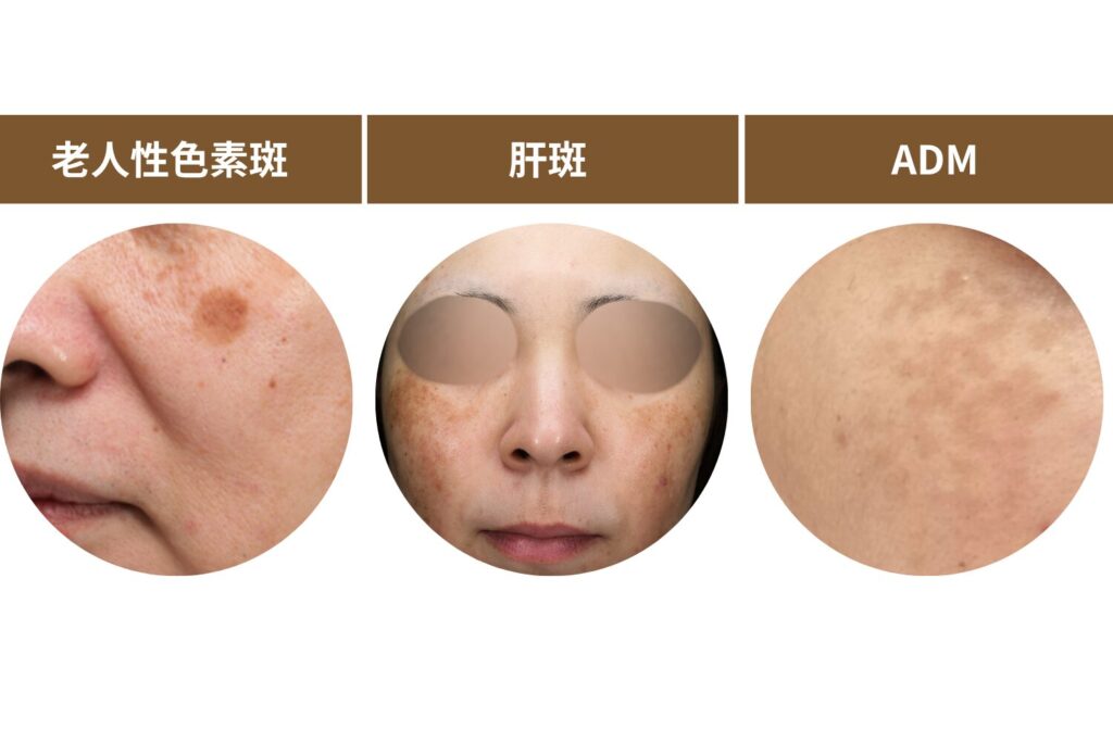 代表的な薄いシミの種類