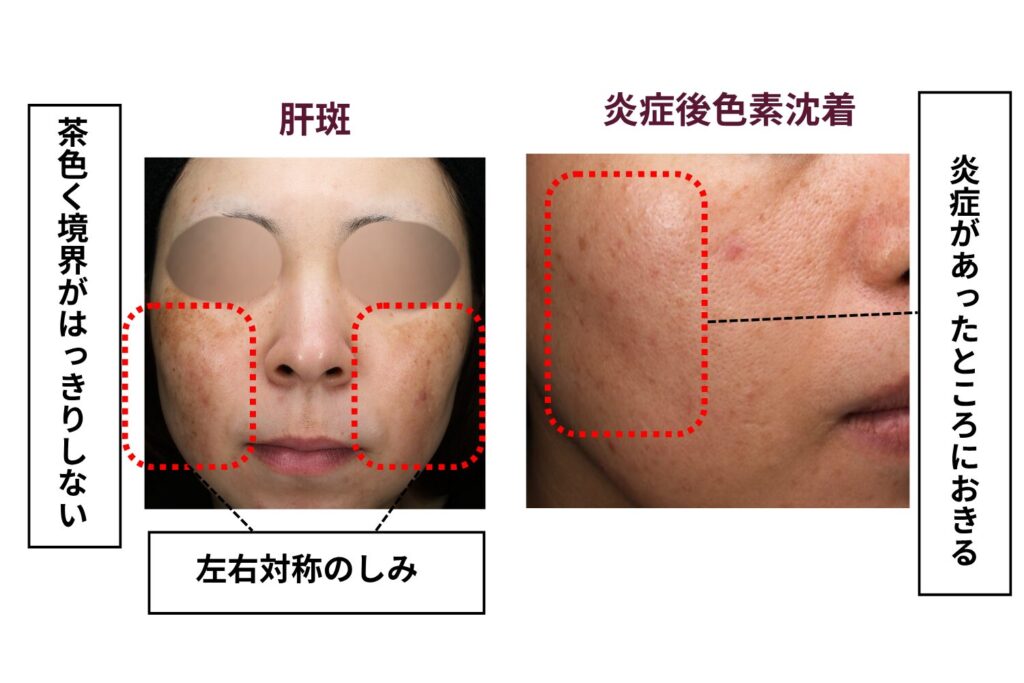 炎症後色素沈着との違い