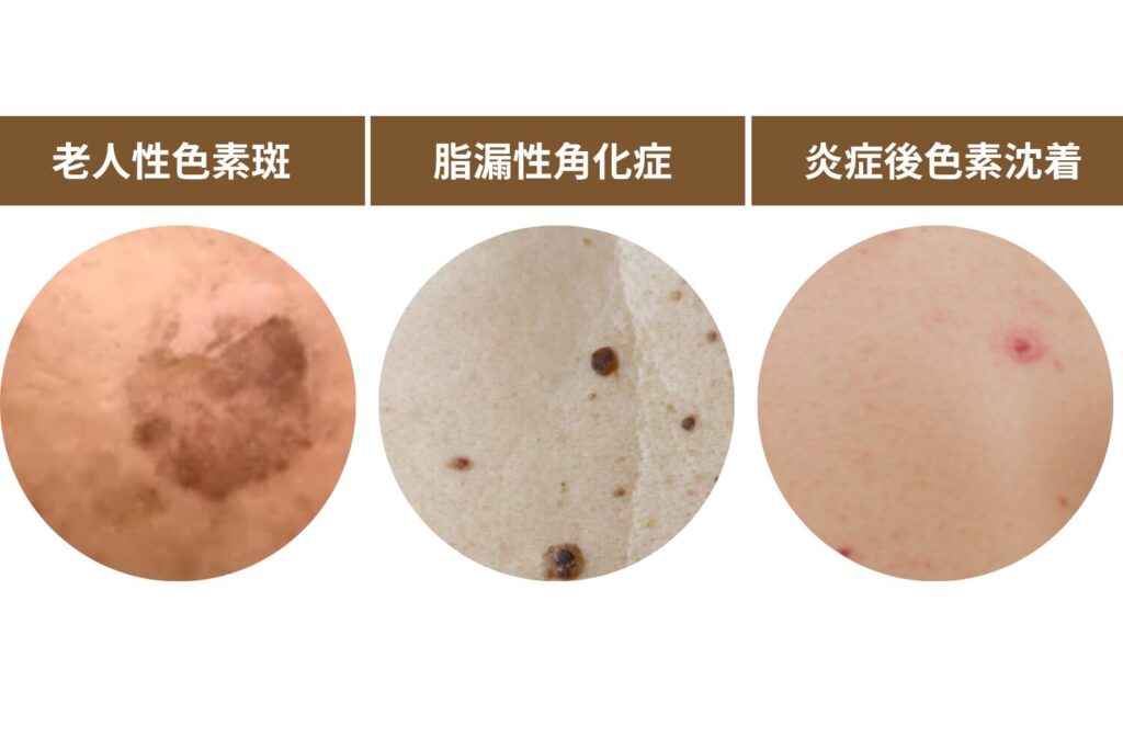 背中にできるシミの代表的な種類