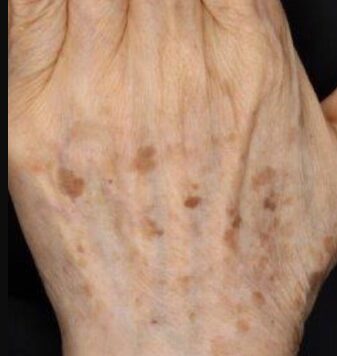 ピコスポットレーザー(濃いシミに)