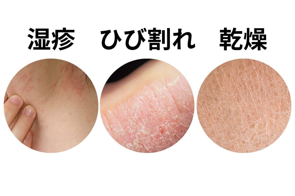 肌荒れや乾燥が強い時期