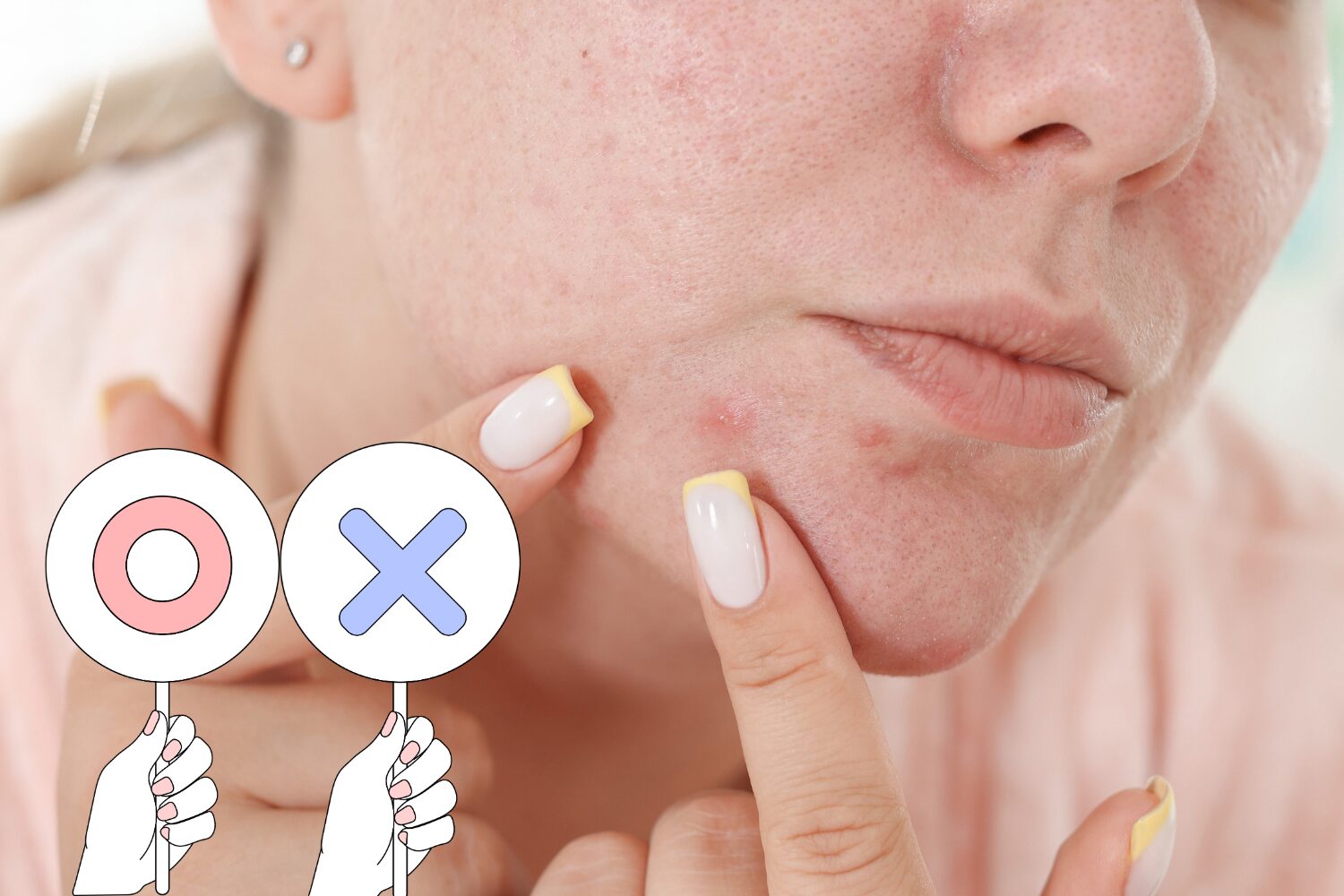 ニキビを潰すのは危険?医師が教える正しい対処法