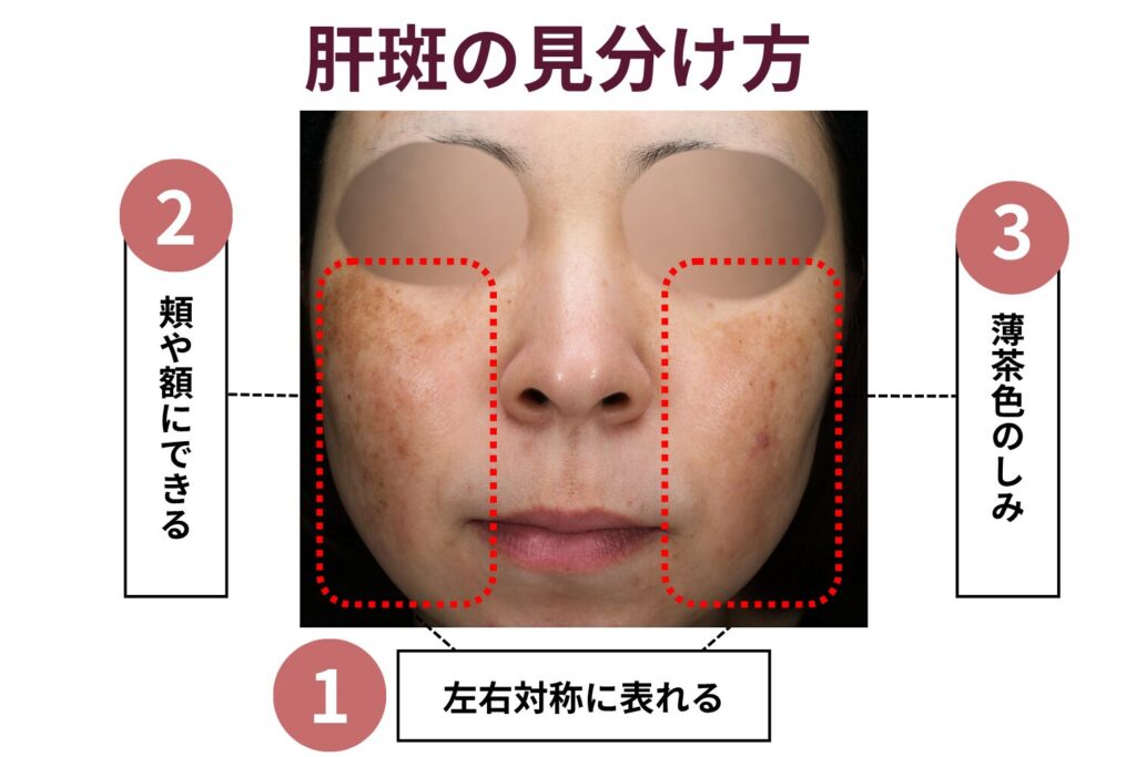 肝斑の特徴と他のしみとの見分け方