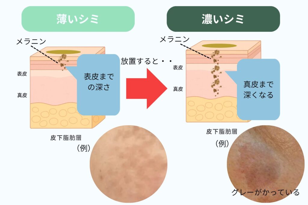 薄いシミができる原因と放置するリスク