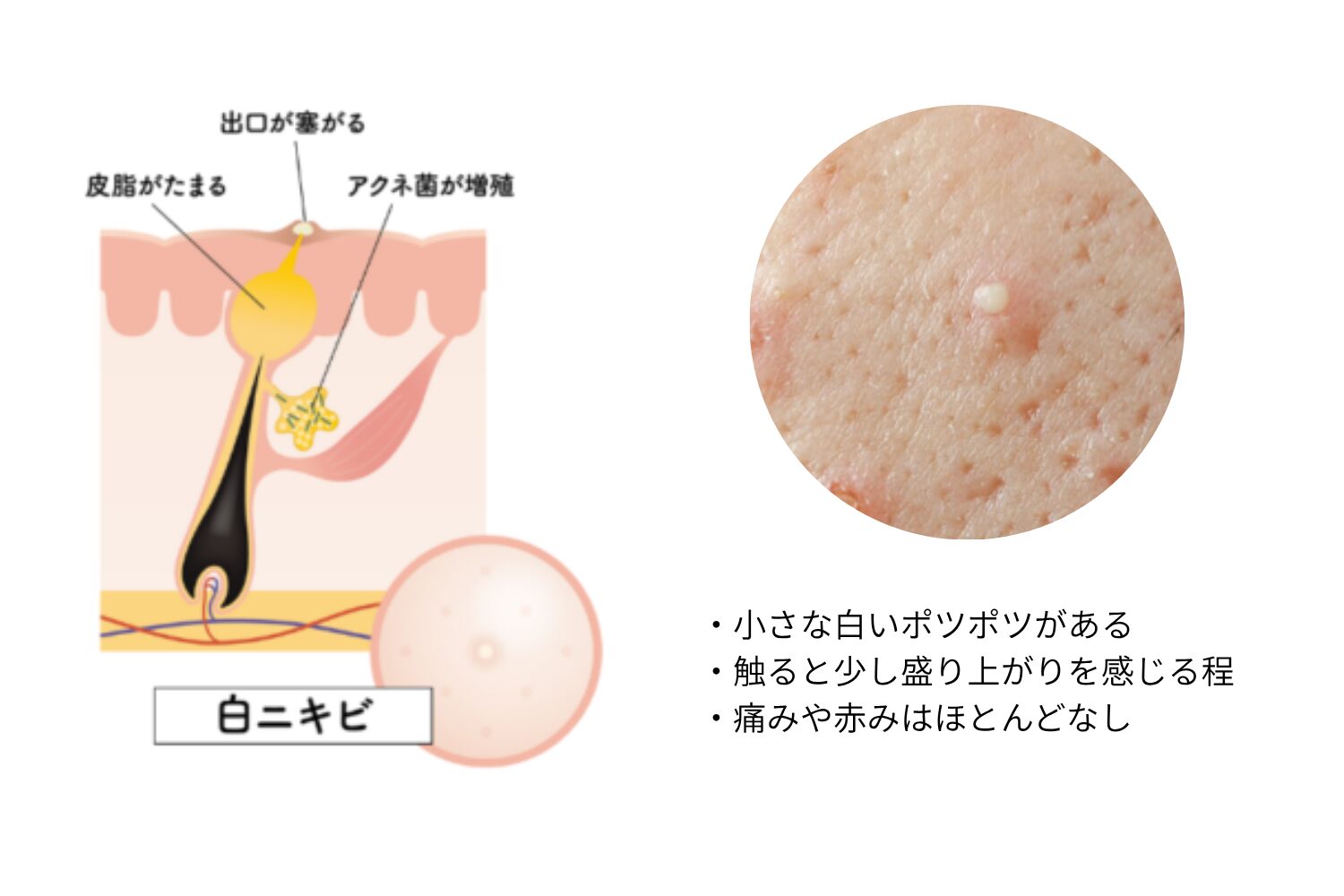 ニキビが眉間にできる原因と治し方|繰り返す前の対策 - ハートライフクリニック(静岡県浜松市の美容皮膚科・美容外科)