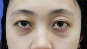 くま取り（30代・女性）