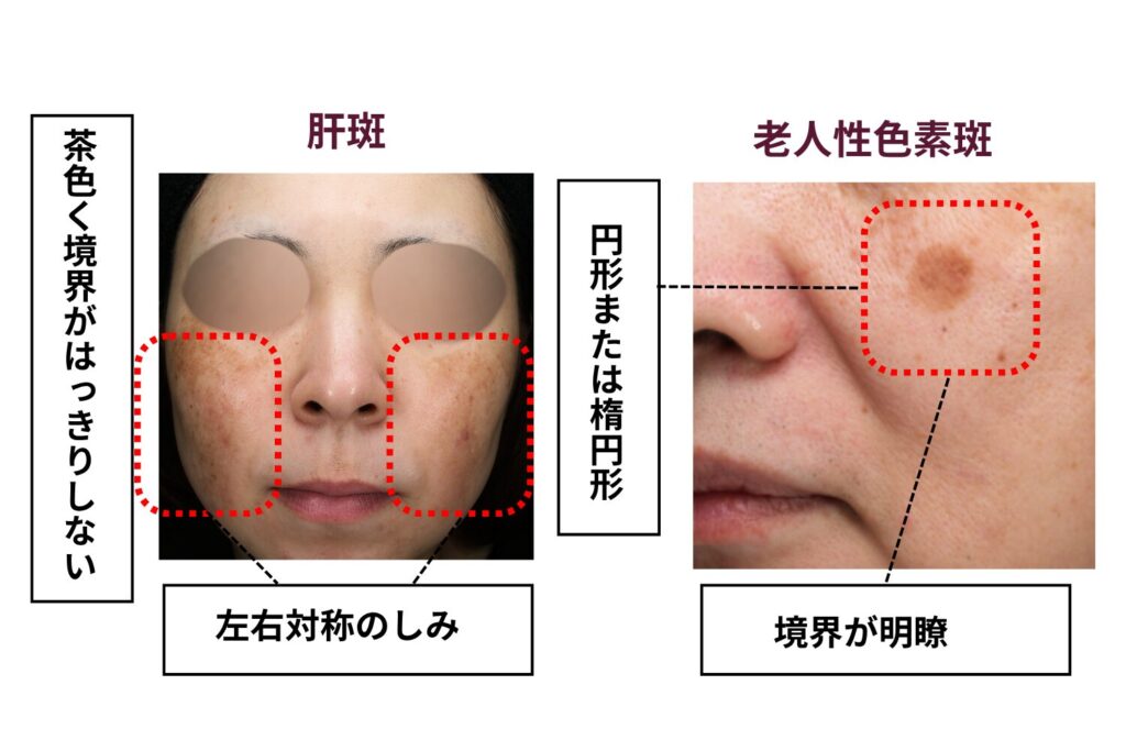 日光性黒子（老人性色素斑）との違い
