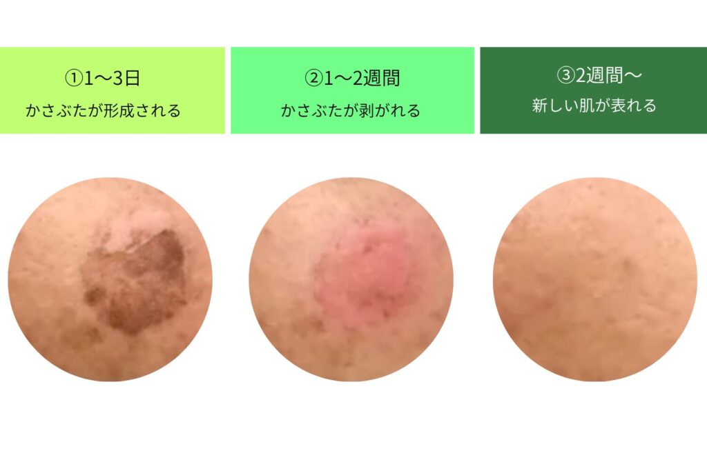 ピコレーザー施術後の経過とダウンタイムを正しく理解する