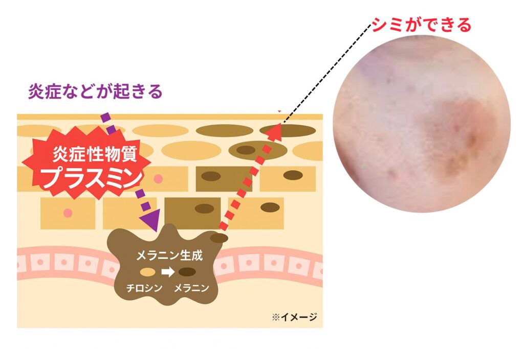 炎症性物質プラスミンの活性化とシミの関係