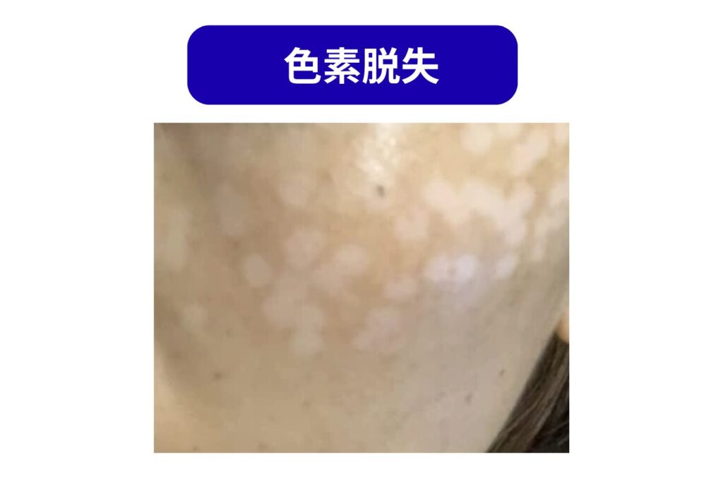 色素脱失ややけど