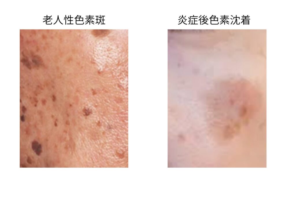 老人性色素斑と炎症後色素沈着