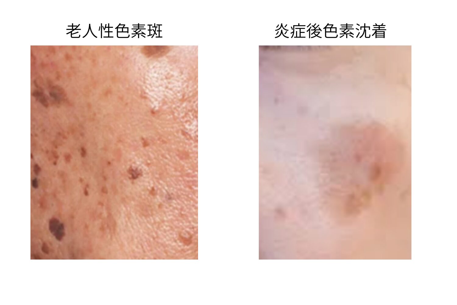 老人性色素斑と炎症後色素沈着