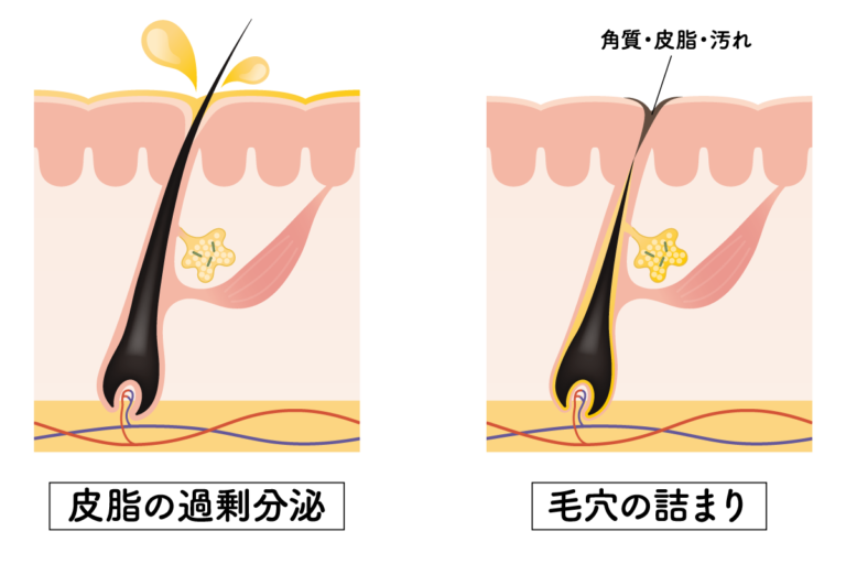 ターンオーバーの乱れと生活習慣の影響|睡眠・食事・ストレスとの関係