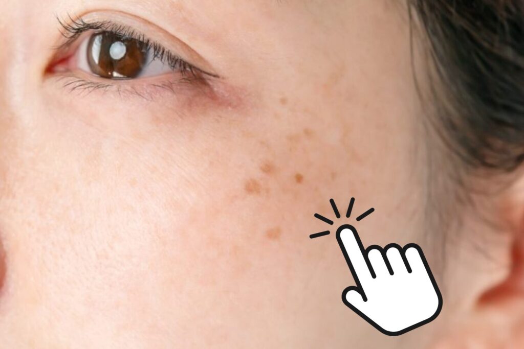 目元のシミを徹底解説|原因・種類・消す方法と治療法