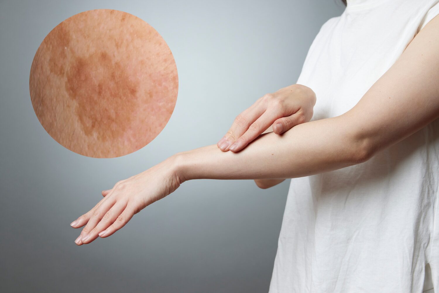 腕のシミを消す！原因・治療法・自宅ケアと予防のすべて