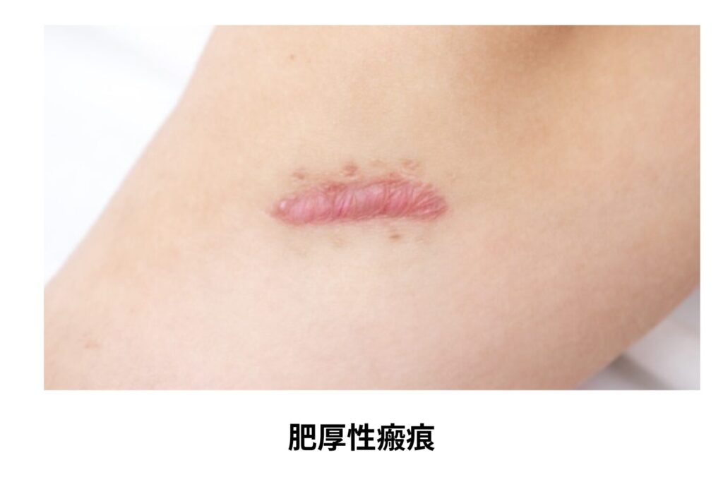 放置すると色素沈着やしこり跡になる?