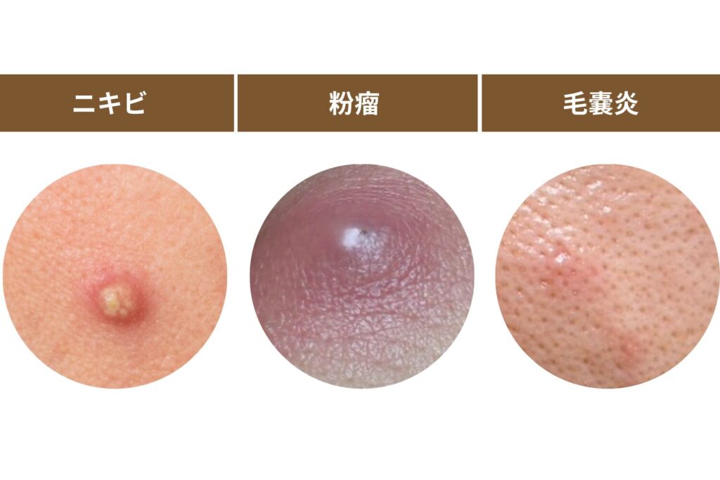 粉瘤や毛嚢炎