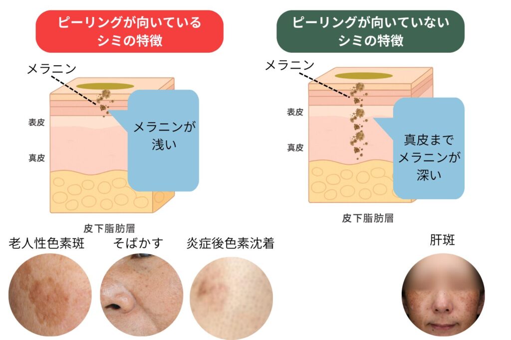 ピーリングの適応となるシミ