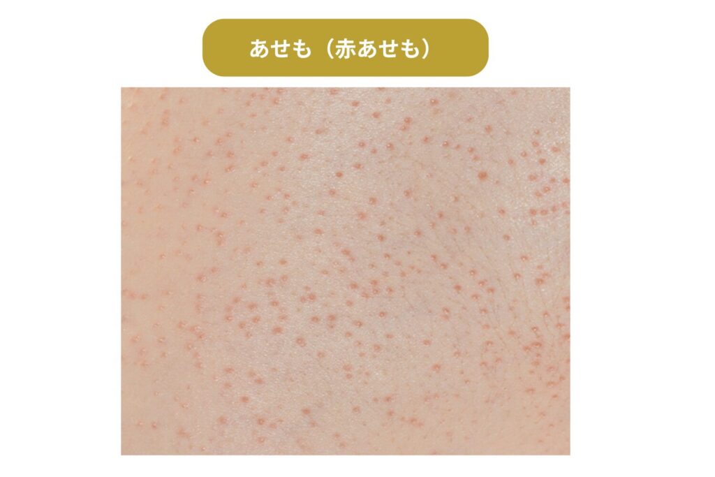 あせも（赤あせも）