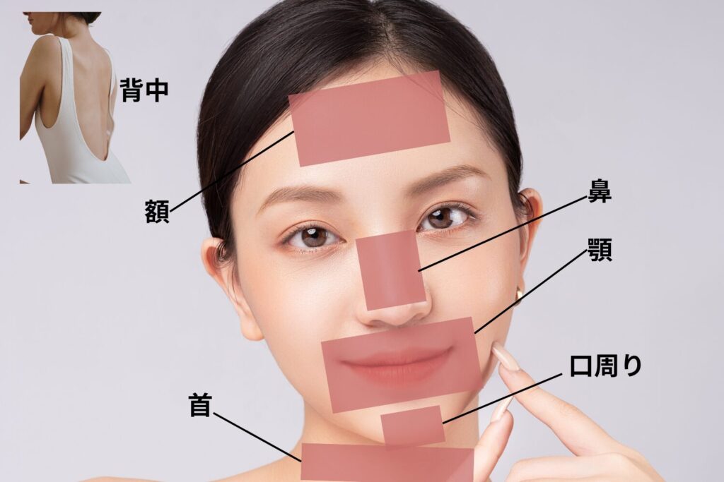 ストレスニキビが出やすい場所と体のサイン