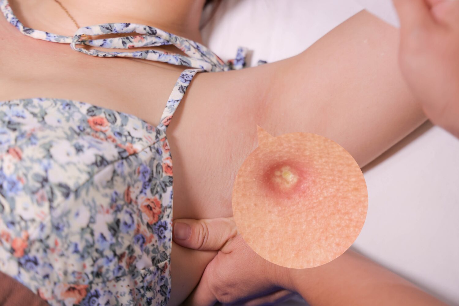 脇のニキビは原因特定と正しいケアで改善|悪化を防ぐ治し方と予防法