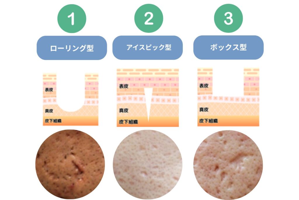 クレーターの種類