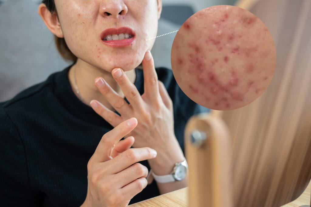 ニキビがかゆい!その原因と原因別の正しい対処法を解説
