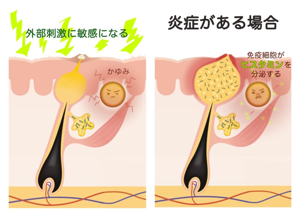 かゆいニキビは原因を見極めれば改善できる