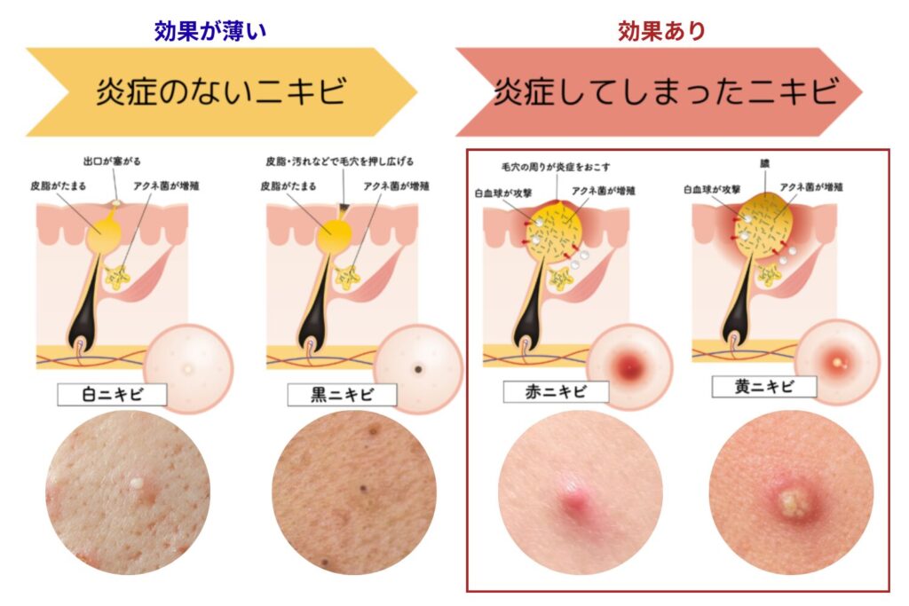 抗生物質が効く症状と効かない症状の違い