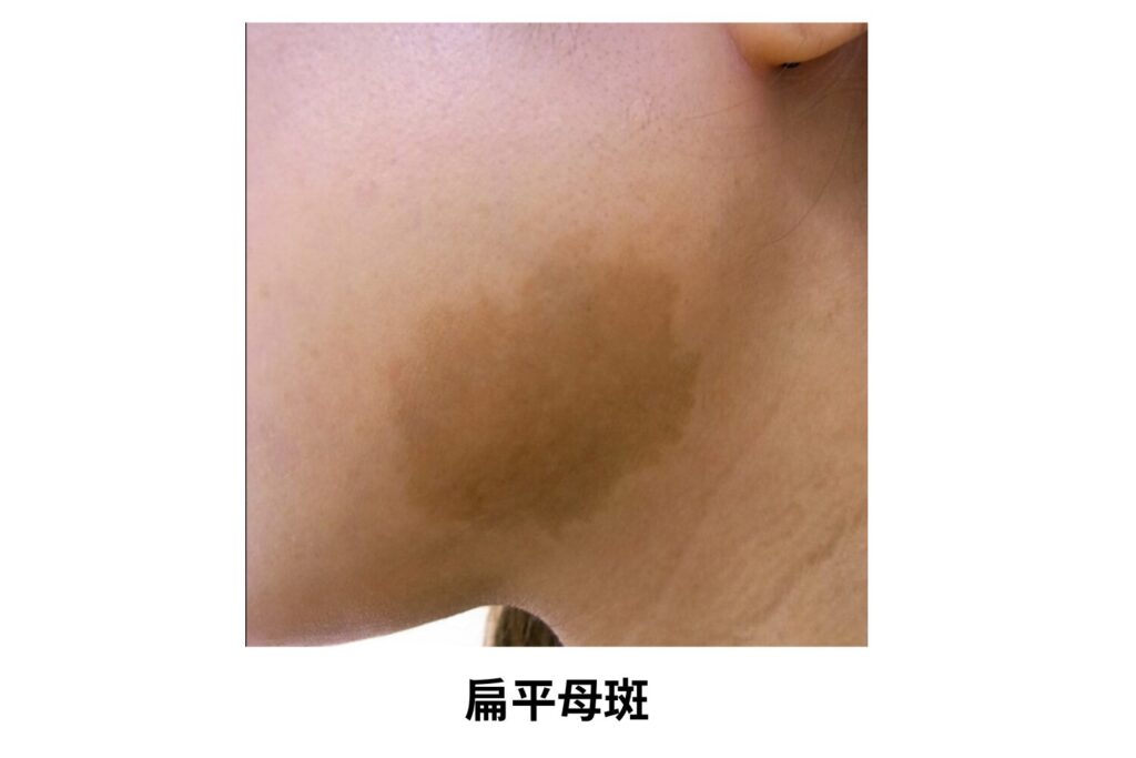 扁平母斑