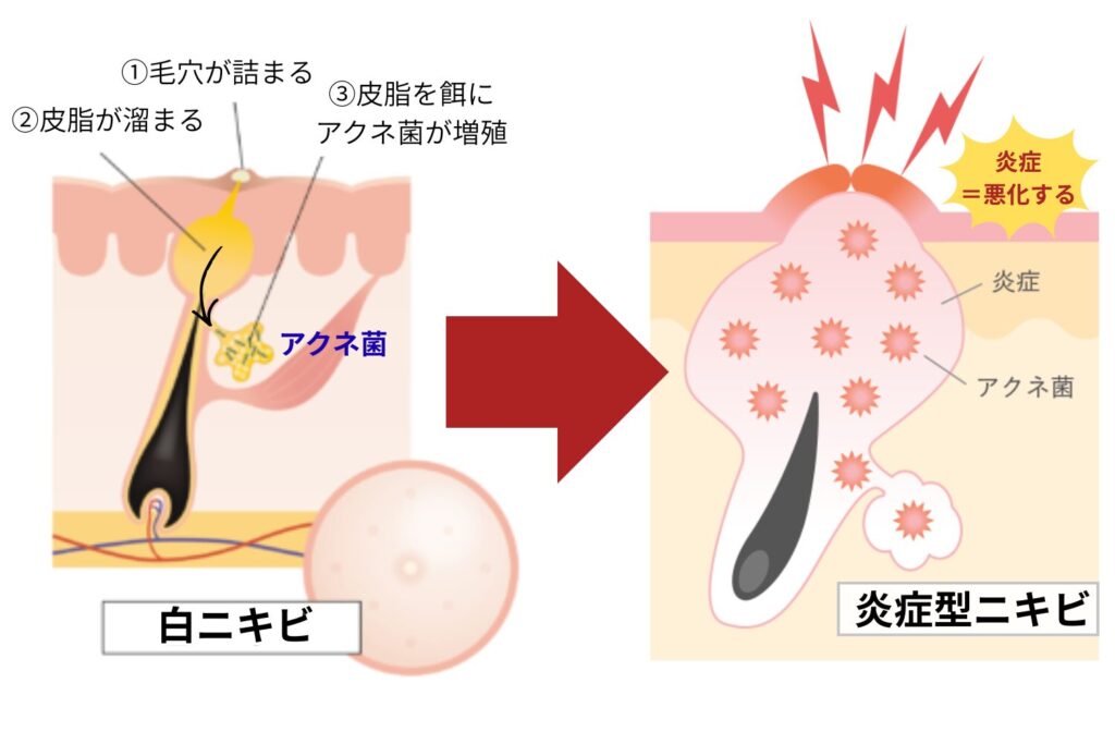 炎症型ニキビへ悪化する流れを