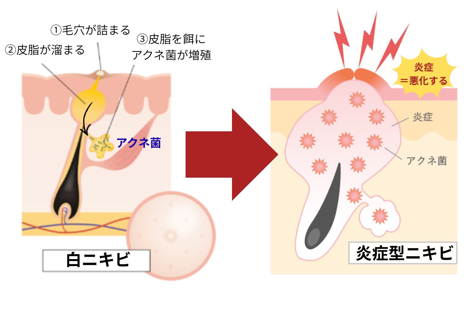 白いニキビは何が原因?正しいケア方法・早く治す習慣をまとめて解説 - ハートライフクリニック(静岡県浜松市の美容皮膚科・美容外科)