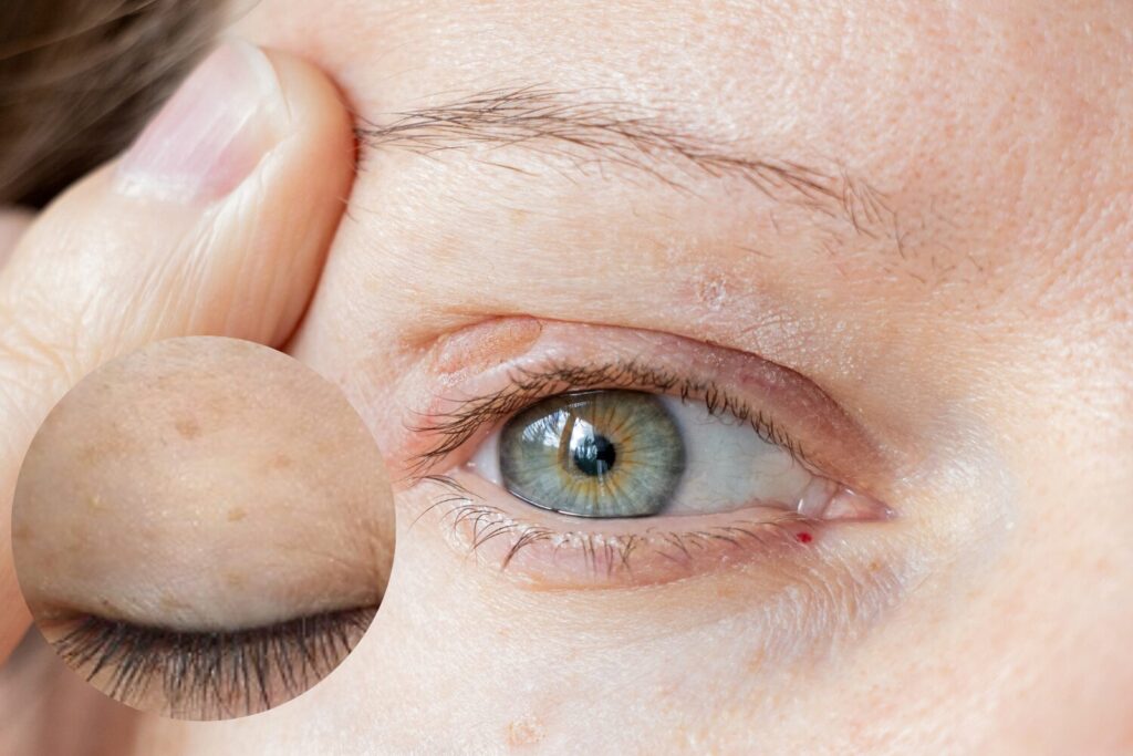 まぶたのシミ取りはどうする？原因・治療法・注意点まで詳しく解...